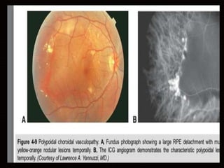Age related macular degeneration | PPTX