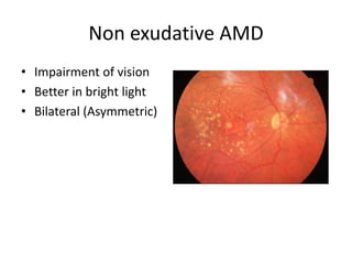 Age related macular degeneration | PPTX
