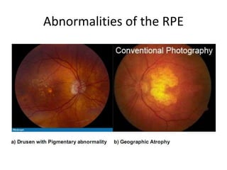 Age related macular degeneration | PPTX