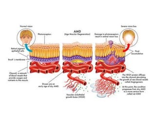 Age related macular degeneration | PPTX
