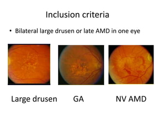 Age related macular degeneration | PPTX