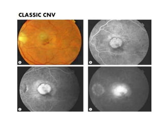 Age related macular degeneration | PPTX