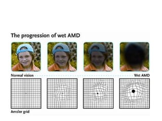 Age related macular degeneration | PPTX