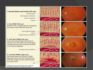 Age related macular degeneration ( | PPTX