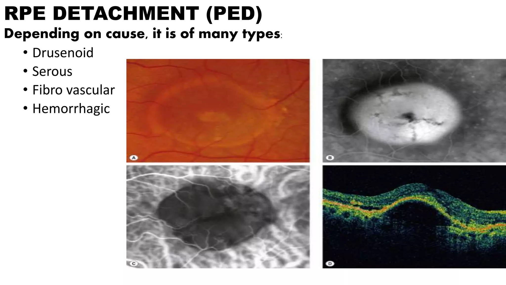 Age related macular degeneration nitin | PPTX