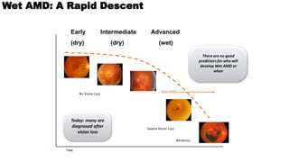 Age related macular degeneration nitin | PPTX