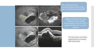 Neovascular AMD | PPTX