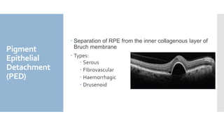 Inner Rpe Neovascular AMD | PPTX