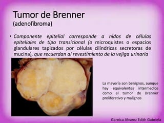 Tumor de Brenner 
(adenofibroma) 
• Componente epitelial corresponde a nidos de células 
epiteliales de tipo transicional (o microquistes o espacios 
glandulares tapizados por células cilíndricas secretoras de 
mucina), que recuerdan al revestimiento de la vejiga urinaria 
La mayoría son benignos, aunque 
hay equivalentes intermedios 
como el tumor de Brenner 
proliferativo y malignos 
Garnica Alvarez Edith Gabriela 
 