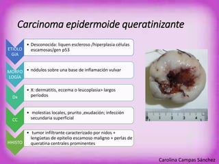 Carcinoma epidermoide queratinizante 
ETIOLO 
GíA 
• Desconocida: liquen escleroso /hiperplasia células 
escamosas/gen p53 
MORFO 
LOGÍA 
• nódulos sobre una base de inflamación vulvar 
Dx 
• X: dermatitis, eccema o leucoplasia> largos 
períodos 
CC 
• molestias locales, prurito ,exudación; infección 
secundaria superficial 
HHISTO 
• tumor infiltrante caracterizado por nidos + 
lengüetas de epitelio escamoso maligno + perlas de 
queratina centrales prominentes 
Carolina Campas Sánchez 
 