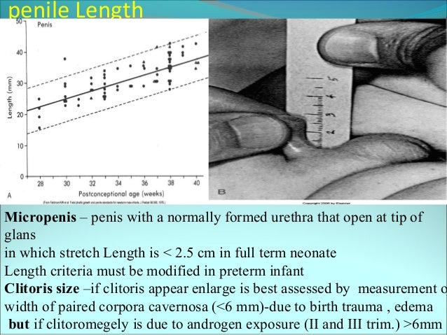 micropenis treatment