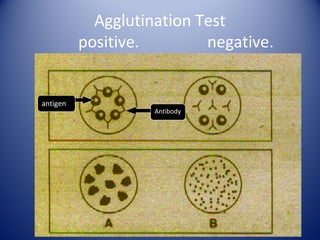 Agglutination Test 
positive. negative. 
Antibody 
. 
antigen 
 