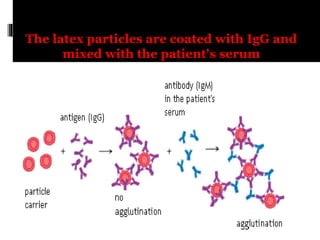 The latex particles are coated with IgG and
mixed with the patient's serum
 