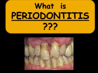 What is
PERIODONTITIS
???
 