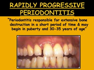 ―Periodontitis responsible for extensive bone
destruction in a short period of time & may
begin in puberty and 30-35 years of age‖
 