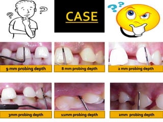 9 mm probing depth 8 mm probing depth 2 mm probing depth
3mm probing depth 11mm probing depth 2mm probing depth
 