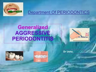 Department Of PERIODONTICS
Generalized
AGGRESSIVE
PERIODONTITIS
Dr Usha.
 
