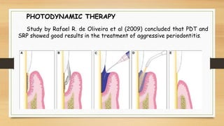 PHOTODYNAMIC THERAPY
Study by Rafael R. de Oliveira et al (2009) concluded that PDT and
SRP showed good results in the treatment of aggressive periodontitis.
 