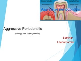 Aggressive Periodontitis
(etiology and pathogenesis)
Seminar :
Leena Parmar
 