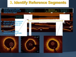 LCX
Dx
LM
MLA 1.95 mm2
Ø = 1.56 mm, AS = 76.5%
LLeseisoionnlelnenggthth2
826mmmm
Area 8.29 mm2
Ø = 3.12 mm
Area 8.32 mm2
Ø = 3.04 mm
Area 8.79 mm2
Ø = 3.25 mm
3. Identify Reference Segments
1) Scroll reference vessel
markers to proximal and
distal lesion edges.
2) Attempt to identify segment
of vessel within 5mm with
at least >180 degrees of
visible EEL
3) Reposition reference
scroll marker accordingly
 