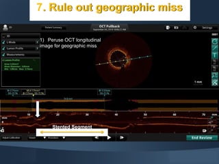 7. Rule out geographic miss
1) Peruse OCT longitudinal
image for geographic miss
Stented Segment
 