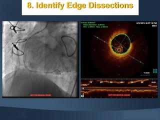 Edge Dissection OCT - few basic facts | PPT