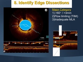 Major Category
1) >60° / >3mm
2)Flow limiting (TIMI)
3)Inadequate MLA
8. Identify Edge Dissections
 
