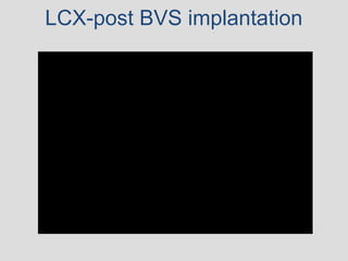 LCX-post BVS implantation
 