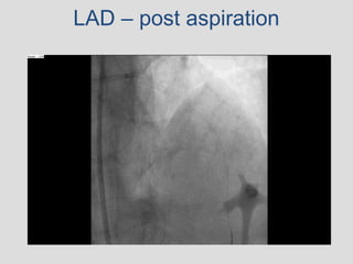 LAD – post aspiration
 