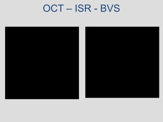 OCT – ISR - BVS
 