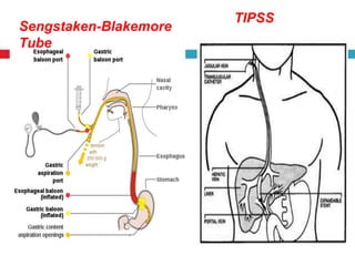 Sengstaken-Blakemore 
Tube 
TIPSS 
 