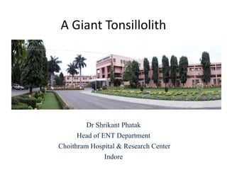 A Giant Tonsillolith
Dr Shrikant Phatak
Head of ENT Department
Choithram Hospital & Research Center
Indore
 