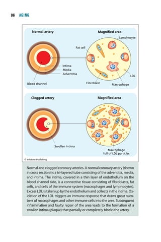   AGING


             Normal artery                                        Magniﬁed area
                                                                                   Lymphocyte


                                               Fat cell




                                   Intima
                                   Media
                                   Adventitia
                                                                                               LDL

        Blood channel                                     Fibroblast
                                                                             Macrophage



            Clogged artery                                        Magniﬁed area




                              Swollen intima
                                                                           Macrophage
                                                                       full of LDL particles
      © Infobase Publishing


        Normal and clogged coronary arteries. A normal coronary artery (shown
        in cross section) is a tri-layered tube consisting of the adventitia, media,
        and intima. The intima, covered in a thin layer of endothelium on the
        blood channel side, is a connective tissue consisting of fibroblasts, fat
        cells, and cells of the immune system (macrophages and lymphocytes).
        Excess LDL is taken up by the endothelium and collects in the intima. Ox-
        idation of the LDL triggers an immune response that draws great num-
        bers of macrophages and other immune cells into the area. Subsequent
        inflammation and faulty repair of the area leads to the formation of a
        swollen intima (plaque) that partially or completely blocks the artery.
 