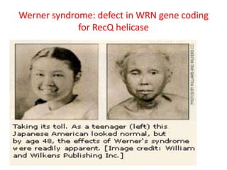 Werner syndrome: defect in WRN gene coding
for RecQ helicase
 