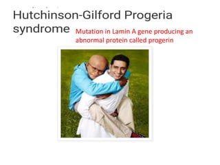 Mutation in Lamin A gene producing an
abnormal protein called progerin
 