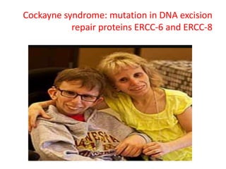 Cockayne syndrome: mutation in DNA excision
repair proteins ERCC-6 and ERCC-8
 