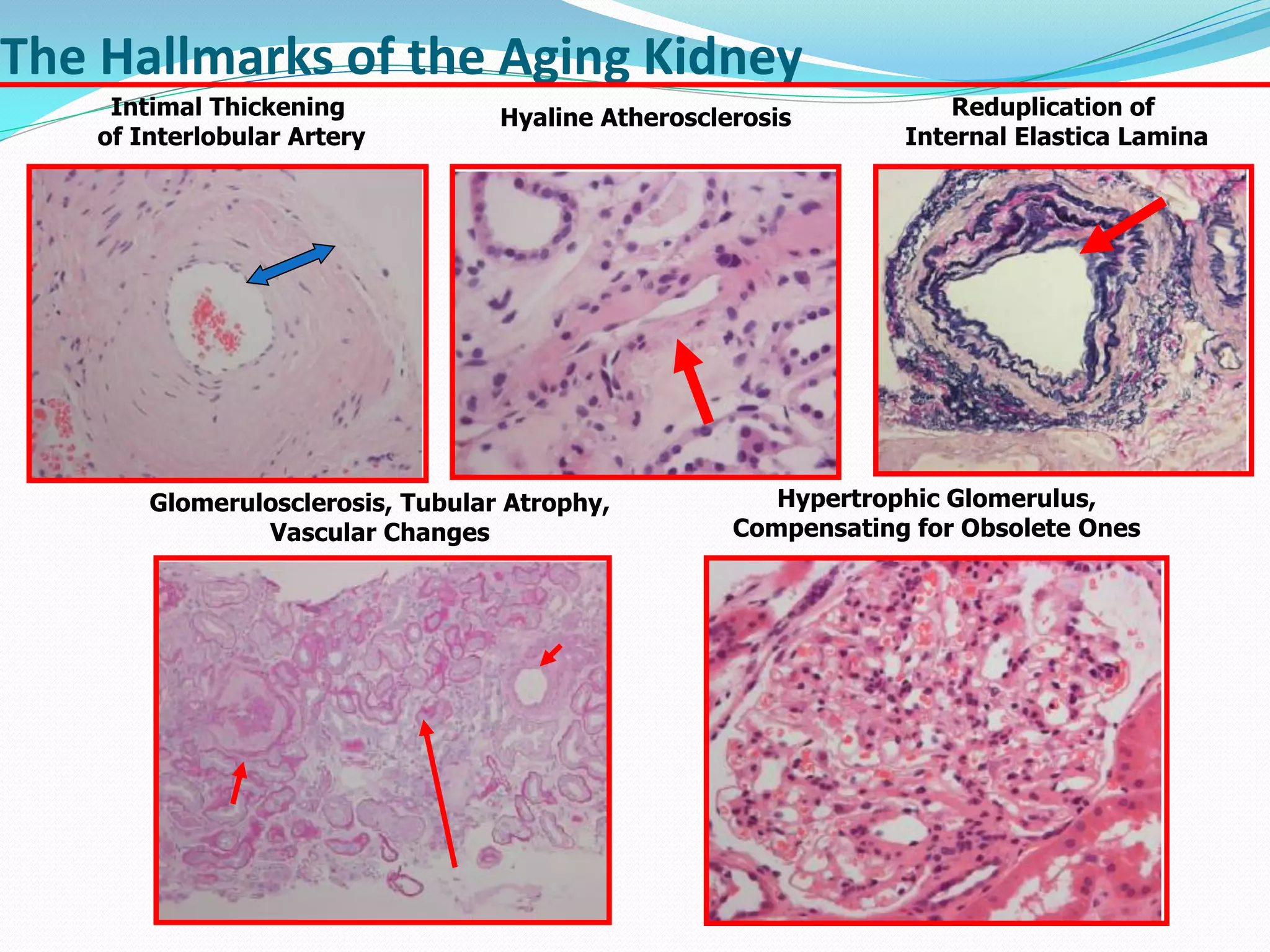 The Hallmarks of the Aging Kidney
Intimal Thickening
of Interlobular Artery
Hyaline Atherosclerosis Reduplication of
Internal Elastica Lamina
Glomerulosclerosis, Tubular Atrophy,
Vascular Changes
Hypertrophic Glomerulus,
Compensating for Obsolete Ones