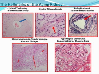 The Hallmarks of the Aging Kidney
Intimal Thickening
of Interlobular Artery
Hyaline Atherosclerosis Reduplication of
Internal Elastica Lamina
Glomerulosclerosis, Tubular Atrophy,
Vascular Changes
Hypertrophic Glomerulus,
Compensating for Obsolete Ones
 