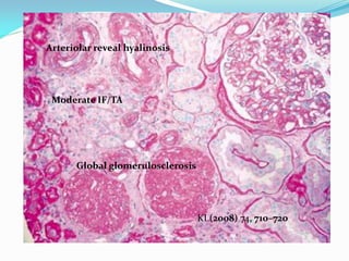 KI (2008) 74, 710–720
Global glomerulosclerosis
Moderate IF/TA
Arteriolar reveal hyalinosis
 