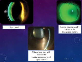 A glimpse through scleral contact lenses (PROSE) | PPTX