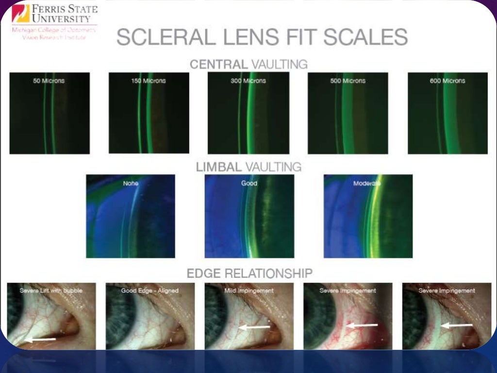 A glimpse through scleral contact lenses (PROSE)
