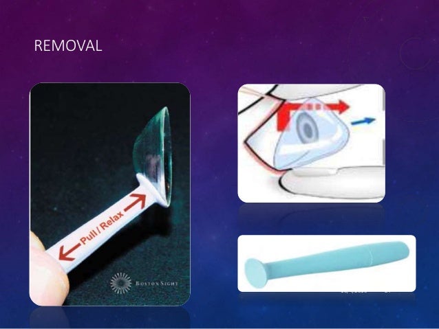 scleral for solution lenses contact scleral A glimpse lenses (PROSE) through scleral for solution lenses contact scleral A glimpse lenses (PROSE) through
