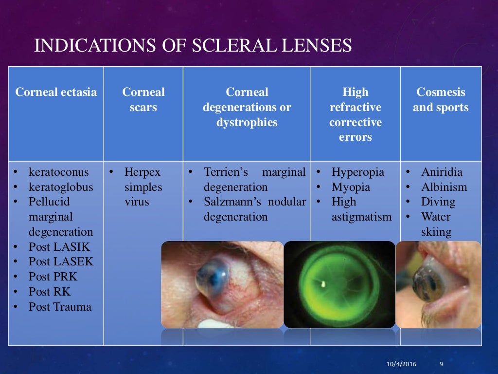 A glimpse through scleral contact lenses (PROSE)