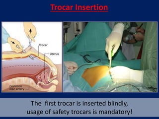 Trocar Insertion
The first trocar is inserted blindly,
usage of safety trocars is mandatory!
 