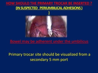 HOW SHOULD THE PRIMARY TROCAR BE INSERTED ?
(INSUSPECTED PERIUMBILICALADHESIONS)
)
Primary trocar site should be visualized from a
secondary 5 mm port
Bowel may be adherent under the umbilicus
 