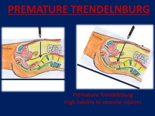 PREMATURE TRENDELNBURG
Premature Trendelnburg
High liability to vascular injuries
 