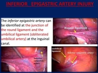 The inferior epigastric artery can
be identified at the junction of
the round ligament and the
umbilical ligament (obliterated
umbilical artery) at the inguinal
canal.
INFERIOR EPIGASTRIC ARTERY INJURY
 