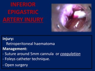 Injury:
Retroperitoneal haematoma
Management:
- Suture around 5mm cannula or coagulation
- Foleys catheter technique.
- Open surgery
INFERIOR
EPIGASTRIC
ARTERY INJURY
 