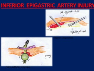 Foleys catheter technique.
Bipolar Coagulation.
INFERIOR EPIGASTRIC ARTERY INJURY
 