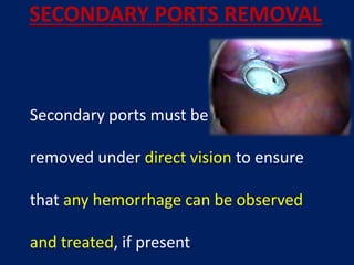 SECONDARY PORTS REMOVAL
Secondary ports must be
removed under direct vision to ensure
that any hemorrhage can be observed
and treated, if present.
 